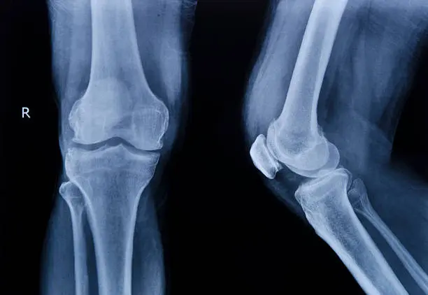 A close up of an x-ray image of the knees