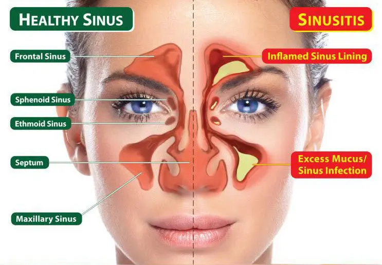 A woman with sinus pressure points on her face.