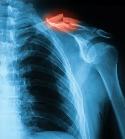 A x-ray of the shoulder and neck with an orange spot.