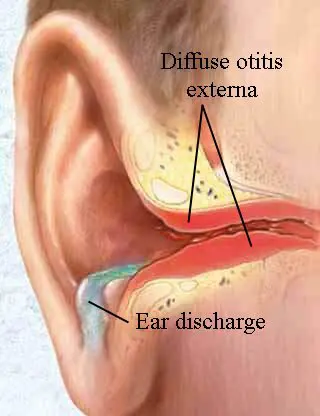 A close up of an ear with the location of diffuse otitis externa and ear discharge.