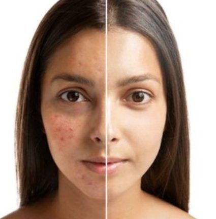 A woman with acne and before and after