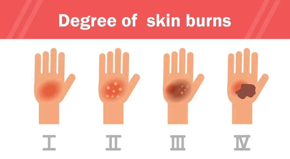 pathophysiology of second degree burns