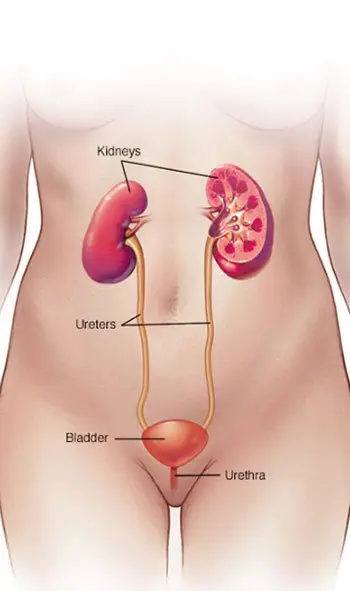 A diagram of the human body showing the kidneys and ursitis.