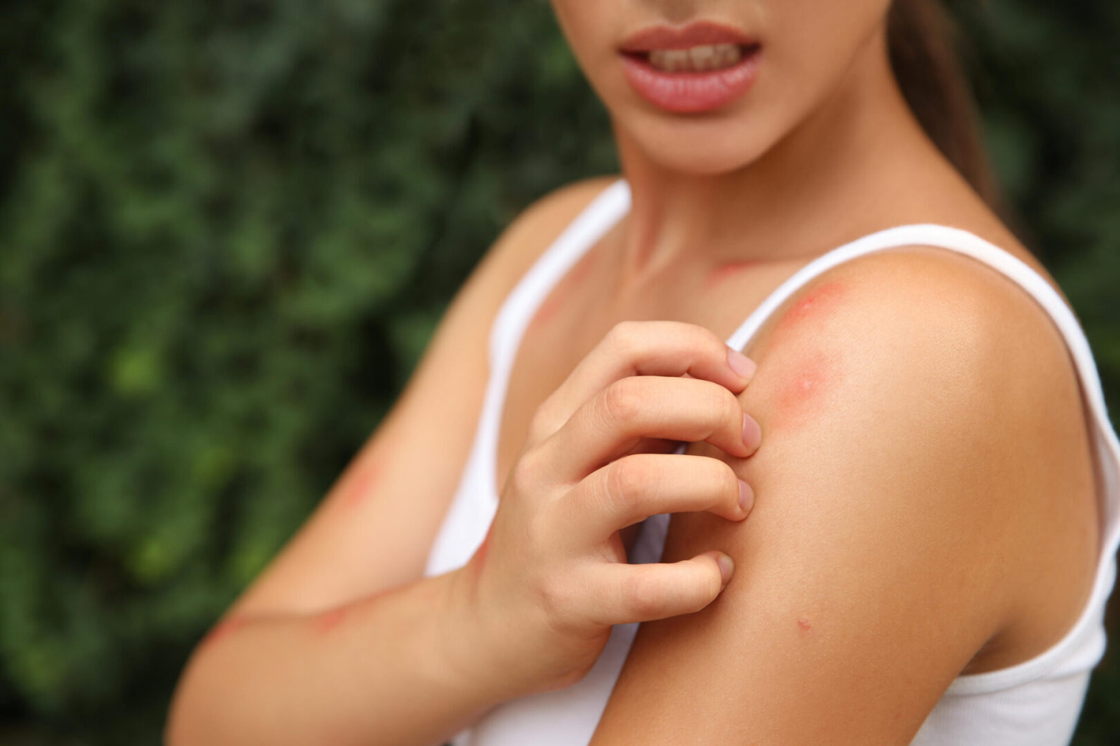 Woman scratching itchy arm with rash.